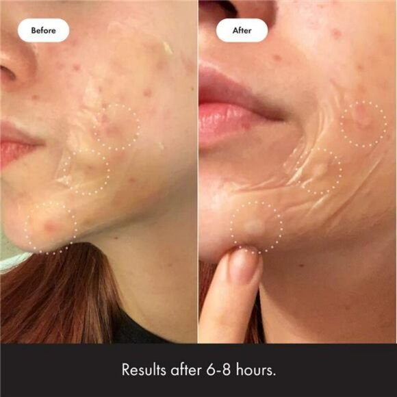 Mighty Patch Surface Acne Pimple Patch for Face Body Chin Forehead 10 Count - Picture 5 of 7